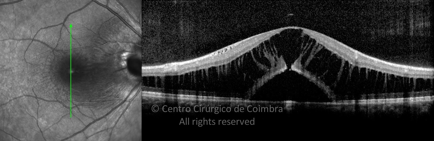 Optic Disc Pits and Associated Serous Macular Detachments - Atlas RL Eye